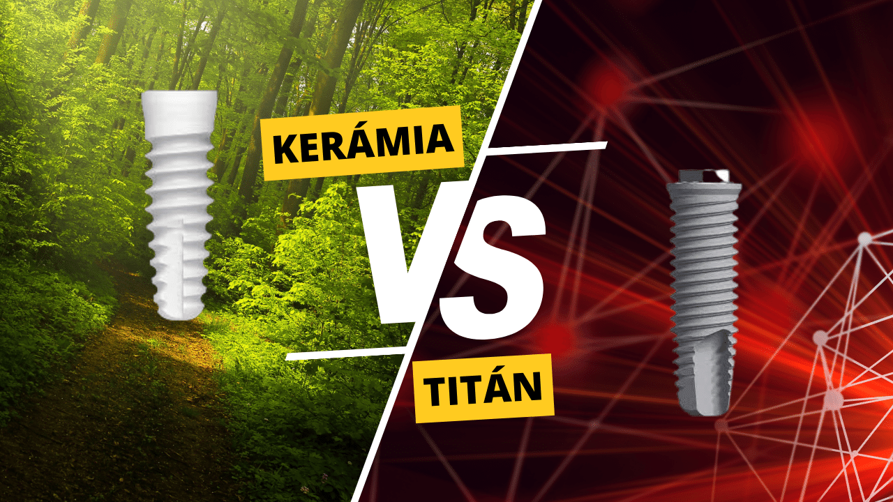 Kerámia vs. titán implantátumok