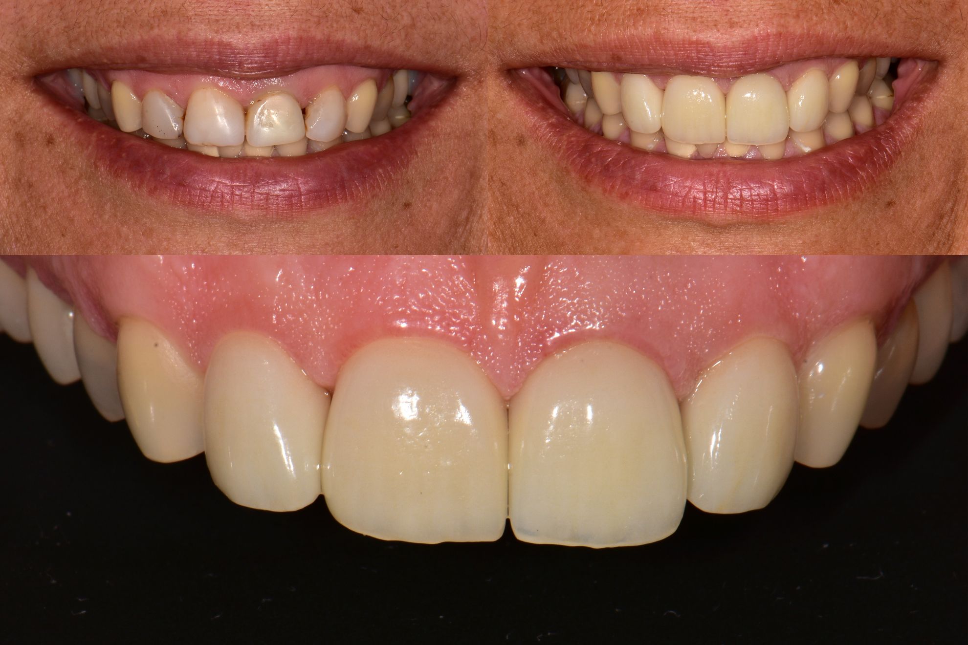 Metal-free e.max dental restorations - Dr. Johanna Malita.jpg